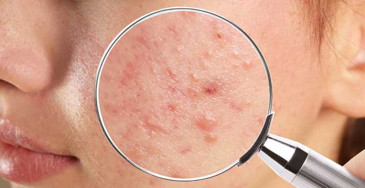 異維A酸有哪些副作用? -- Yeung Ho Hong,楊浩康