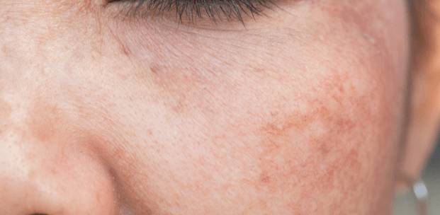 甚麼是賀爾蒙斑? -- Yeung Ho Hong,楊浩康