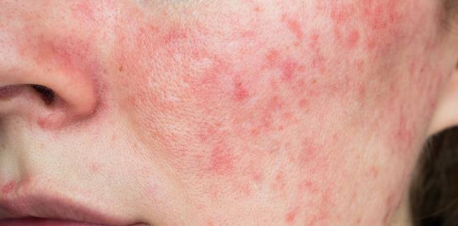 面上的紅疹 - 玫瑰痤瘡 (Rosacea) -- Yeung Ho Hong,楊浩康