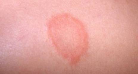 皮膚真菌感染 -- Yeung Ho Hong,楊浩康