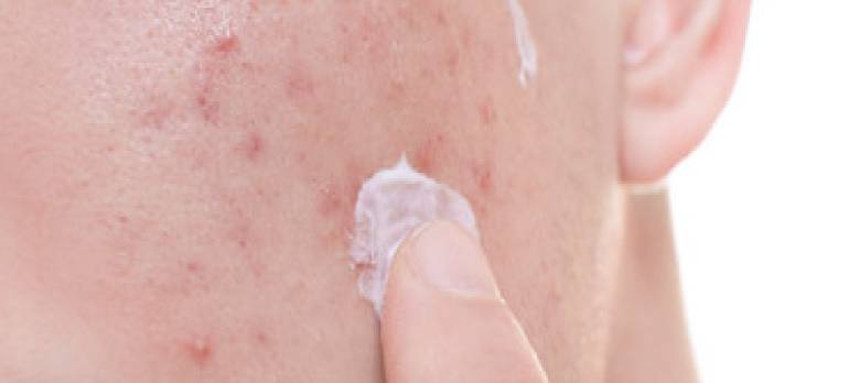 外用藥膏治療暗瘡 -- Yeung Ho Hong,楊浩康