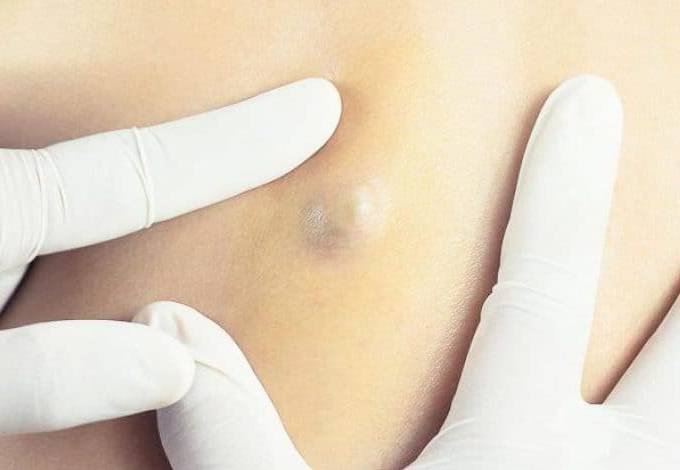 甚麼是粉瘤？ -- Yeung Ho Hong,楊浩康