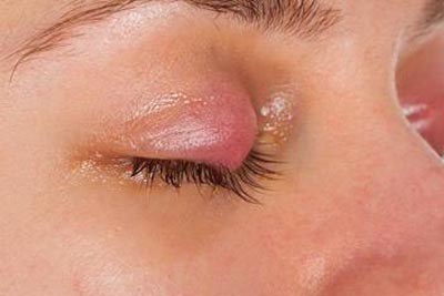 眼瞼囊腫 -- Yeung Ho Hong,楊浩康